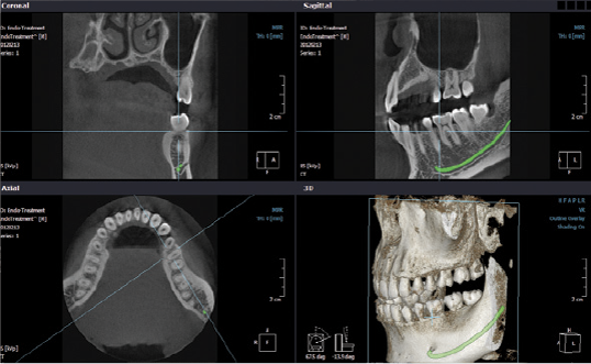 Dentascan Cone Beam 3D